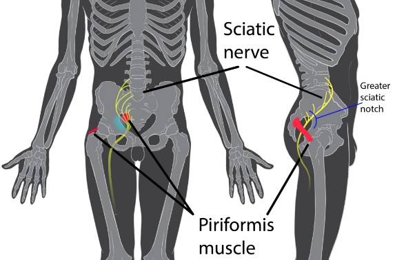 What You Need To Know About Sciatica - Symptoms, Causes, Diagnosis And ...